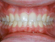 This patient had spacing and alignment problems with the upper teeth and a deep overbite. The overbite was corrected, teeth aligned and spaces closed.